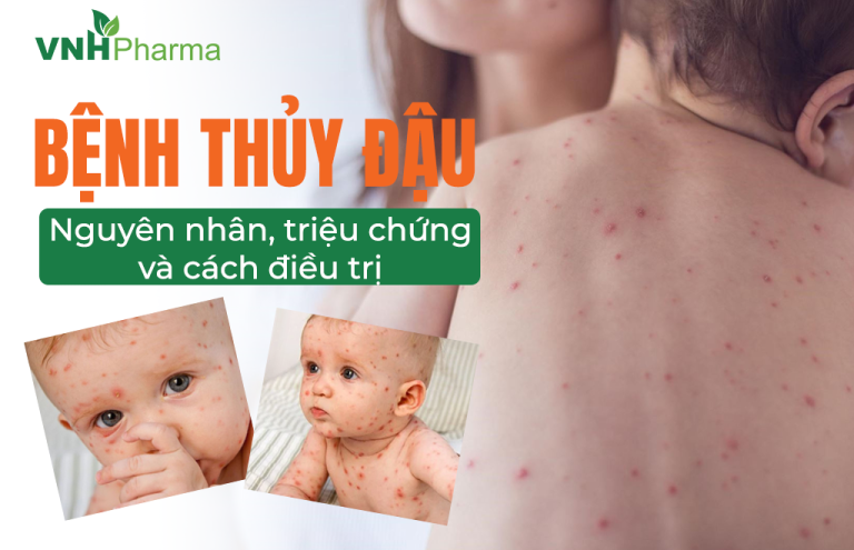 BỆNH THUỶ ĐẬU  VÀ TẤT CẢ NHỮNG ĐIỀU MẸ CẦN BIẾT