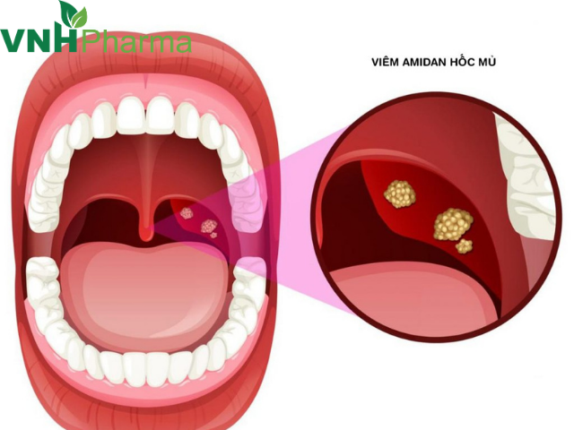 Nguyên nhân và cách điều trị khi trẻ bị viêm amidan có mủ