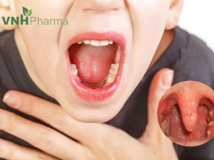 Cách chữa viêm họng hạt có mủ tại nhà