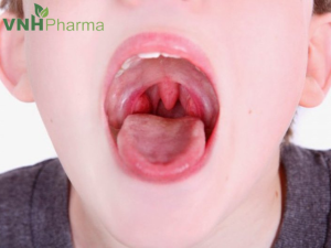 Cách điều trị viêm amidan tái đi tái lại