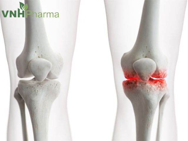 Thoái Hóa Khớp – Nguyên Nhân – Cách Phòng Tránh