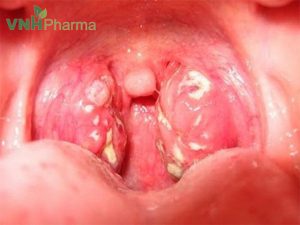 Dấu hiệu trẻ bị amidan – Ăn gì tốt cho trẻ bị viêm amidan